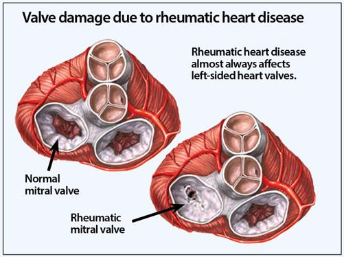 rheumatic heart